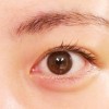 網膜はくり　症状や手術の体験談　術後の見え方は？